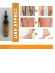 Herbal Varicose Veins Relief Spray for Pain & Swelling