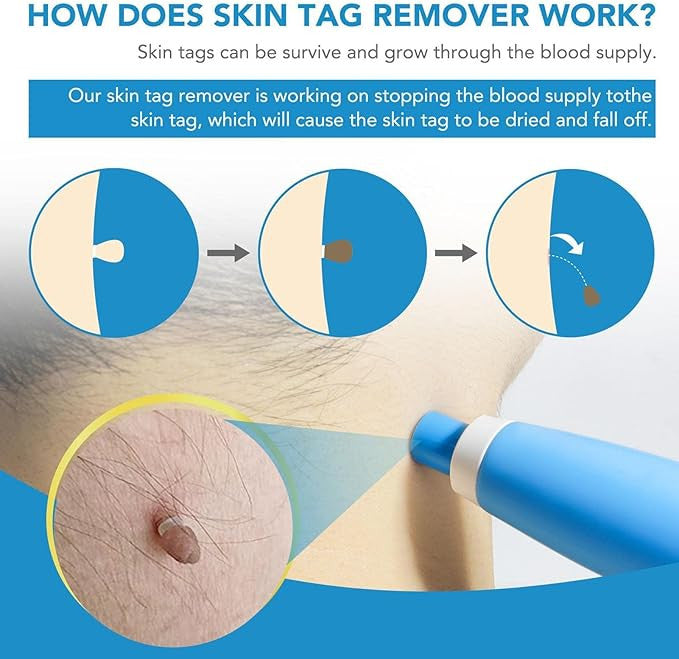 Painless 2-in-1 Auto Skin Tag Remover Kit for Safe, Easy Removal