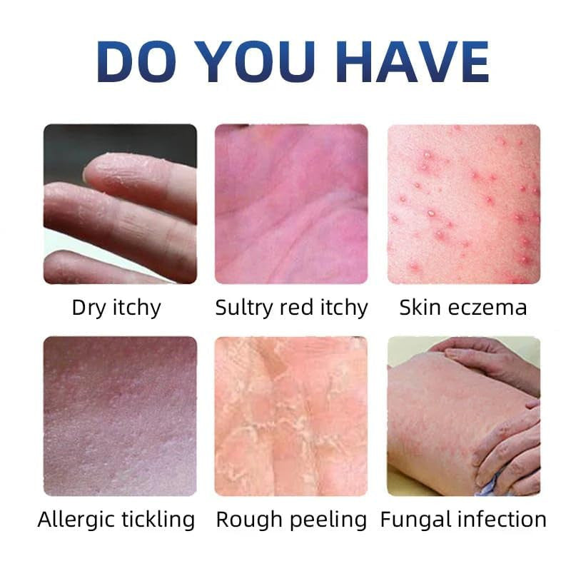Anti-Fungal Skin Care Cream for Ringworm, Eczema & Itching