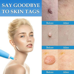 Painless 2-in-1 Auto Skin Tag Remover Kit for Safe, Easy Removal