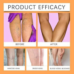 Herbal Varicose Veins Relief Spray for Pain & Swelling
