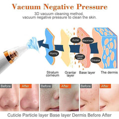 6-in-1 Blackhead Remover & Pore Vacuum