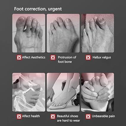 Advanced Toe Straightener for Perfect Alignment and Comfort