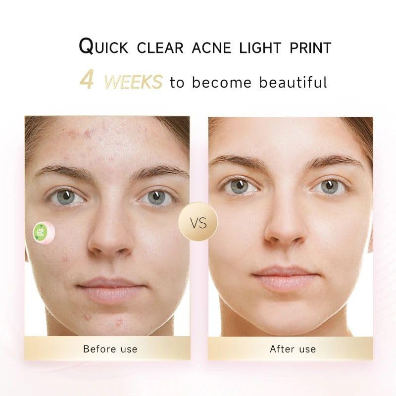 Electronic Acne Patches with Red Light Therapy for Clear Skin