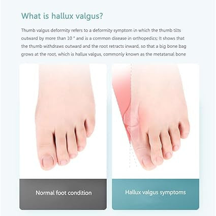Advanced Toe Straightener for Perfect Alignment and Comfort