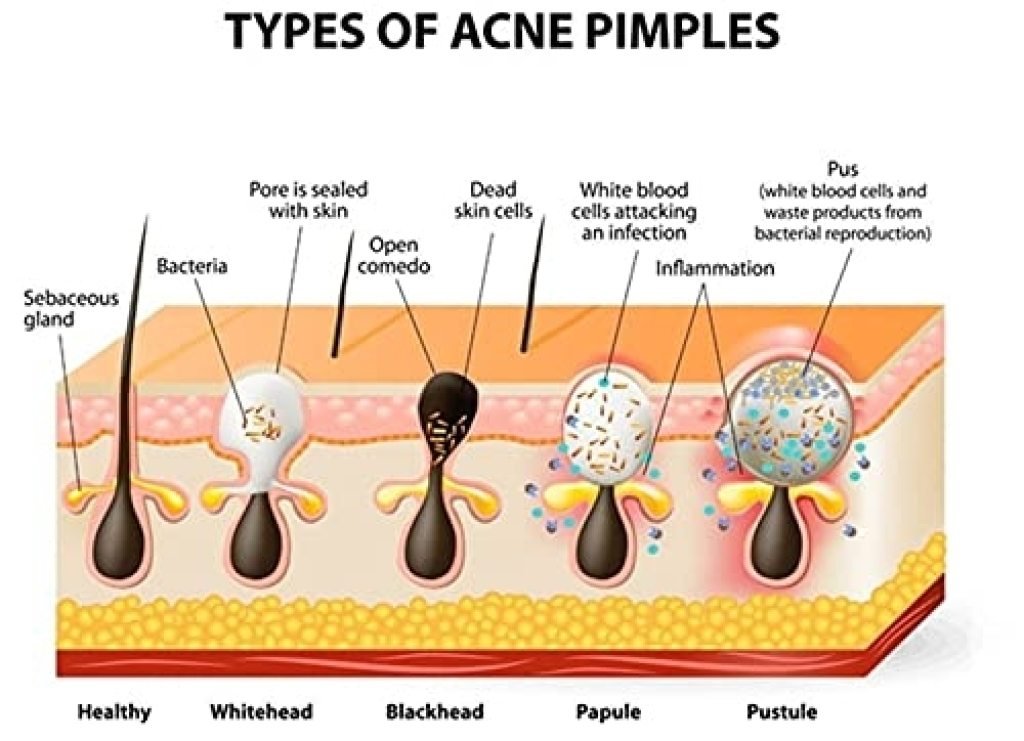 Blackhead Remover Nose Strips – Deep Pore Cleansing with Aloe & Charcoal