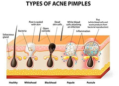 Blackhead Remover Nose Strips – Deep Pore Cleansing with Aloe & Charcoal